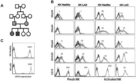 Figure 1. Profile of NK cells derived from a LAD-III patient. (A) Family pedigree of the LAD-III patient. Striped symbols represent the heterozygous parents; full gray symbols, LAD-III patients; and the X symbol, the sibling who unfortunately died. (B) Freshly derived (2 left columns) and IL-2–activated (2 right columns) NK cells were obtained from the LAD-III patient and from a healthy control (indicated above the histograms). NK cells were stained for the expression of various activating receptors (indicated at the left part of the figure). Numbers in the figure indicates median fluorescence intensity of the gray histograms. (C) NK cells from the LAD-III patient and from a healthy control (indicated in the left part of the figure) were stained for the expression of LFA-1. (B-C) Black empty histogram represents the staining of the cells with a control mAb; gray empty histogram, specific staining. Figure shows 1 representative experiment of 3 performed.