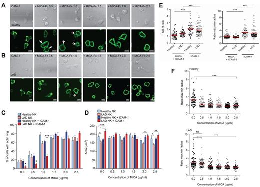 Figure 3. The activation threshold for NKG2D-mediated F-actin polymerization and for symmetric spreading is altered in LAD-III NK cells. (A) Representative bright-field (top panels) and fluorescence images of F-actin (bottom panels) for healthy NK cells stimulated on surfaces coated with ICAM-1 (2.5 μg/mL) with increasing concentrations of MICA-Fc (0-2.5 μg/mL). (B) Representative bright-field (top panels) and fluorescence images of F-actin (bottom panels) for LAD-III NK cells stimulated as in panel A. White arrows indicate activated cells. Bars represent 10 μm. (C) The proportion of healthy or LAD-III NK cells forming a peripheral ring of F-actin in response to surfaces coated with poly lysine and indicated concentrations of MICA-Fc (light blue and pink, respectively) or surfaces coated with ICAM-1 and indicated concentrations of MICA-Fc (blue and red, respectively). Data are mean ± SEM from 4 independent experiments; n = 50-90. ***P < .0005 (1-way ANOVA). *P < .05 (1-way ANOVA). (A-C) A complete ring of actin filaments is scored as a synapse, whereas an interrupted or patchy ring represents a kinapse. (D) The area of cells attached to the slide surface, as assessed by IRM imaging, was measured for healthy NK cells and LAD-III NK cells on surfaces coated with ICAM-1 and increasing concentrations of MICA-Fc (blue and red, respectively) and for healthy and LAD-III NK cells on surfaces coated with poly lysine and increasing concentrations of MICA-Fc (light blue and pink, respectively). Data are mean ± SEM from 4 independent experiments; n = 50. ***P < .0005 (1-way ANOVA). **P < .005 (1-way ANOVA). *P < .05 (1-way ANOVA). (E) The distance from the cell centroid of phalloidin-AlexaFluor488-stained healthy or LAD-III NK cells to the circumference was measured at 360 radii. The symmetry of the cells stimulated on ICAM-1–coated slides with or without MICA-Fc (2.5 μg/mL) is represented as the SD of the radial distances and the ratio of maximum and minimum lengths; n = 50-90. ***P < .0005. (F) The ratio of maximum and minimum lengths for healthy or LAD-III NK cells stimulated on surfaces coated with ICAM-1 and indicated concentrations of MICA-Fc; n = 50-90. *P < .05. NS indicates not significant.