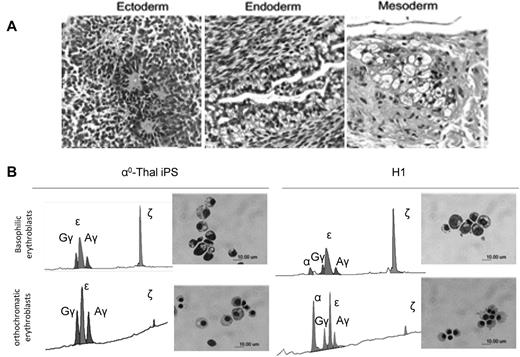 Figure 2. Differentiation of reprogrammed α-thalassemia fibroblasts. (A) H&E staining demonstrating that iPSCs derived from α-thalassemia fibroblasts with transgene-free method can form teratoma in NSG mice, and generate cells from the 3 germ layers (bar = 50 μm). (B) HPLC analysis of globin expression and morphology of the erythroblasts obtained after differentiation of α0-thal-iPSCs and control H1 hESCs. (Top panels) Basophilic erythroblasts obtained after 14 days of coculture on FH-B-hTERT and 14 days of liquid culture. (Bottom panels) Orthochromatic erythroblasts obtained after an additional 10 days of liquid culture. (Left panels) HPLC profiles and Giemsa staining of cells obtained after differentiation of α0-thal-iPSCs. (Right panels) Same as left panels but for control H1 hESCs. α0-thal-iPSCs do not express any α-globin chains. Zeta-globin chains are silenced between the 14th and the 24th day of liquid culture.