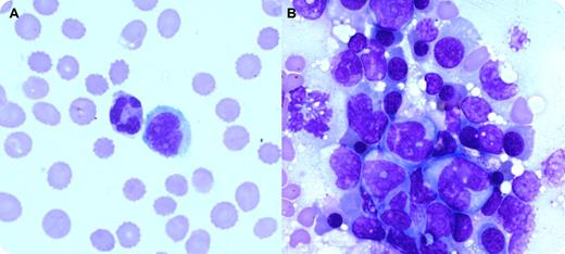 A 33-year-old female with a history of a live related renal transplant on azathioprine and prednisolone and tacrolimus was asymptomatic until 3 years later when she developed low-grade fever, epigastric discomfort, and headache. She had hepatosplenomegaly but no lymphadenopathy. Complete blood counts revealed pancytopenia with hemoglobin 79g/L, leukocyte count 2.6 × 109/L, platelet count 38 × 109/L, and 3 nucleated red cells per 100 leukocytes. The peripheral blood film revealed a few large atypical mononuclear cells with convoluted/bilobed nuclei (see figure panel A). Bone marrow aspirate was hypercellular with clusters of atypical mononuclear cells, especially prominent on biopsy touch imprints (see figure panel B). The cells had large convoluted nuclei, opened chromatin, prominent nucleoli, and moderate amount of basophilic cytoplasm. The biopsy affirmed hypercellularity with malignant-appearing cells that were positive for CD20 and showed strong membranous positivity. A diagnosis of posttransplantation lymphoproliferative disorder (PTLD) was made, classified further as diffuse large B-cell lymphoma. The patient received R-CHOP (rituximab, cyclophosphamide, doxorubicin, vincristine, and prednisolone) that resulted in symptomatic improvement and regression in spleen size. / Hematologic abnormalities such as cytopenia may occur in transplant patients because of immunosuppressive drugs, infections, and malignancies. This case illustrates the value of a review of the peripheral smear. The discovery of abnormal cells prompted a bone marrow examination that provided the diagnosis of PTLD.