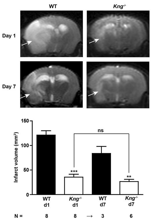 Figure 4. KNG deficiency provides sustained protection from ischemic stroke and does not increase the risk of intracranial hemorrhage. (Top) Serial coronal T2-weighted gradient echo MR images show extensive hyperintense (bright) ischemic lesions (white arrows) on day 1 and day 7 after tMCAO in wild-type (WT) mice, whereas the infarctions are mainly restricted to the basal ganglia in Kng−/− mice. Hypointense (dark) areas indicative of intracerebral hemorrhage were always absent in both groups. One representative panel per group is depicted. (Bottom) MRI-based infarct volumetry confirms significantly smaller infarct volumes and excludes delayed infarct growth in Kng−/− mice after tMCAO (N = 3-8 per group and time point). Alleged shrinkage of strokes between day 1 and day 7 is because of fogging effects during infarct maturation. Note that 5 of 8 WT mice died between day 1 and day 7 after tMCAO and were no longer available for the second MRI examination. ***P < .001, **P < .01, 2-way ANOVA followed by Bonferroni multiple comparison test compared with WT mice or Kng−/− mice; ns indicates not significant.