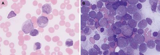 A 26-year-old male was evaluated for chest pain and was found to have a white cell count of 63 000 per cubic millimeter, hemoglobin 10.5 g/dL, platelets 102 000 per μL, with 18% blasts and promyelocytes (panel A). Bone marrow was hypercellular, with promyelocytes and myeloblasts (panel B), some with deeply clefted nuclei. This was morphologically consistent with acute promyelocytic leukemia hypergranular variant. However, FISH for t(15:17) translocation and variant translocations were negative. FISH and cytogenetics revealed t(9;22) translocation. A diagnosis of chronic myeloid leukemia (CML) blast crisis with promyelocytes was made. He had a complete hematologic, cytogenetic, and molecular remission after treatment with cytarabine, arabinoside, daunorubicin, and dasatinib and subsequent matched allogeneic bone marrow transplant. / Promyelocytic blast crisis can be associated with t(15;17) and also t(9;22) translocation or it can occur de novo CML promyelocytic blast crisis. This case highlights the importance of interpreting morphologic clues in context with available diagnostic tests to determine the appropriate treatment recommendations.