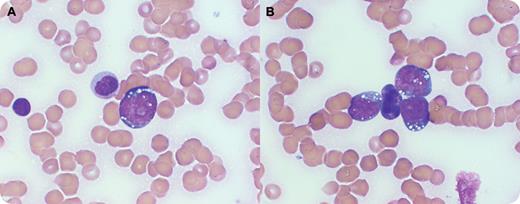 A 47-year-old male with headaches for 2 months developed slurred speech. Physical examination showed a large, 7-cm left neck mass and splenomegaly. Complete blood count revealed leukocytosis (33.3 × 109/L), normocytic anemia (11.5 g/dL), and thrombocytopenia (20 × 109/L). The peripheral smear (panels A and B) revealed markedly decreased platelets, mild anisocytosis, multiple blasts (38%), some with vacuoles, and prominent nucleoli and occasional folded nuclei. The bone marrow biopsy showed diffuse infiltration by medium-sized blasts with high Ki-67/MIB, compatible with Burkitt lymphoma (BL). A diagnosis of leukemic phase of BL was made. / The neurologic symptoms prompted brain imaging that was negative. However, a lumbar puncture showed the presence of lymphoid cells with the same characteristics as the malignant lymphoma. Finally, HIV testing was positive. The patient was started on intrathecal methotrexate and high-dose intravenous chemotherapy, but died shortly afterward from septicemia. / Adult Burkitt lymphoma and Burkitt cell leukemia are rare, aggressive B-cell malignancies currently recognized by the proposed World Health Organization classification of lymphoid neoplasms as a single entity. Improved outcomes have been noted with modern combination chemotherapy. BL can be endemic (African), sporadic, or associated with AIDS. AIDS-related BL carries the worst prognosis. This patient also had leptomeningeal lymphoma.