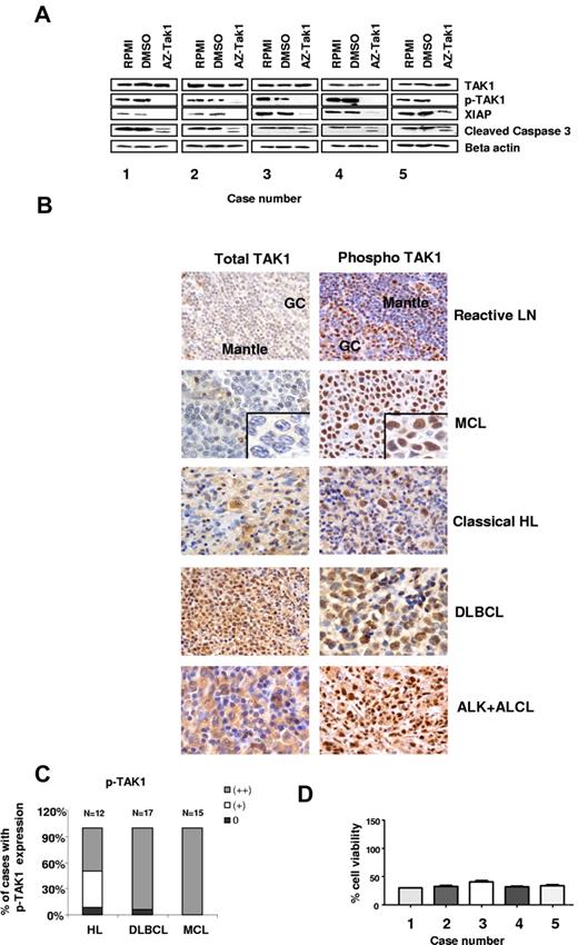 Figure 6. Effect of AZ-TAK1 on primary lymphoma cells. (A) TAK1 and pTAK1 are abundantly expressed in primary MCL cells. Incubating the cells with 300nM of AZ-TAK1 for 24 hours inhibited TAK1 phosphorylation, down-regulated XIAP, and cleaved caspase 3. (B) TAK1 expression in lymph node sections of primary MCL, classic HL, DLBCL, and ALK (+) ALCL cases. Sections of an infiltrating ductal breast carcinoma and a reactive lymph node (LN) were used as positive and negative controls, respectively. Representative staining of negative case (blastoid type), moderately positive (+), and strongly positive (++) MCL cases are shown. (C) Summary of primary cases expressing pTAK1 by IHC (D) Primary lymphoma cells were incubated with 300nM of AZ-TAK1 for 24 hours before cell viability was determined by the use of the MTS assay. Results are the mean of 3 experiments (± SEM).