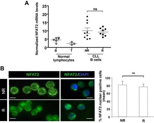 Figure 3. NFAT2 is overexpressed and to some extent localized into the nucleus of CLL B cells. (A) Relative NFAT2 transcript levels were assessed by quantitative RT-PCR from freshly isolated normal blood peripheral B and T lymphocytes (normal lymphocytes B and T; n = 6 and n = 3, respectively) and from CLL B cells from NR and R cases (n = 17). NFAT levels were normalized to Abelson expression. (B) Freshly purified CLL B cells (n = 10) were immunostained with anti-NFAT2 antibody. Nuclei were counterstained with 4,6-diamidino-2-phenylindole. One representative case of each CLL group (NR and R) is presented. Images were acquired using confocal laser-scanning microscope (TCS SP2; Leica). Scale bars represent 5 μm. Single optical sections were obtained with high numerical aperture lens (63 × 2.8 NA) to determine the percentage of NFAT2-positive nuclei in NR and R cells and graphed on the right histogram; an average of 90 cells/sample (6 samples) were analyzed. No statistical difference was observed (ns).