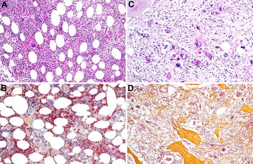 Figure 1. Bone marrow histopathology in polycythemia and postpolycythemia myelofibrosis. (A) Case of PV showing hypercellular BM with trilineage proliferation of all hematopoietic lineages, including prominent megakaryocytes (original magnification ×350). PAS indicates periodic acid-Schiff reaction. (B) Case of PV by immunohistochemistry revealing red-stained neutrophil granulopoiesis and dark-blue nucleated erythropoietic precursors as well as loose clusters of small to large megakaryocytes (original magnification ×350; AS-D-chloroacetate esterase reaction). (C) Case of post-PV myelofibrosis showing decrease in overall cellularity and only a few small and loose erythropoietic islets, abnormal megakaryocytes, and greatly extended stroma compartment (original magnification ×350). PAS indicates periodic acid-Schiff reaction. (D) Case of post-PV myelofibrosis revealing effacement of hematopoiesis by dense bundles of (yellow-brownish) collagen and reticulin fibers associated with osteosclerosis enclosing few dispersed megakaryocytes (original magnification ×350; Gomori silver impregnation technique).