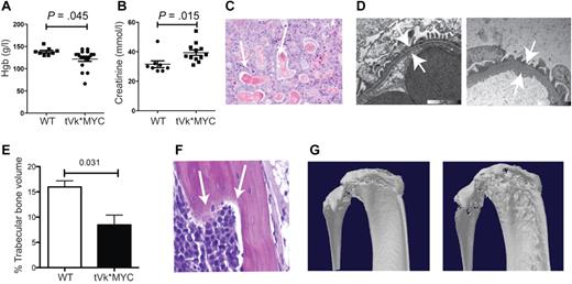 Figure 3. Characterization of transplanted Vk*MYC mice. (A) Peripheral blood hemoglobin and (B) plasma creatinine levels from tVk*MYC mice compared with nontumor-bearing controls. (C) Renal cast nephropathy, typical of autopsy findings from terminal mice bearing aggressive tVk*MYC MM. (D) Transmission electron microscopy of the glomerular basement membrane (GBM) from a normal C57BL/6 mouse compared at the same magnification to GBM from a tumor-bearing mouse. Note diffuse GBM thickening indicating glomerulopathy. (E) Tibial trabecular bone volume of tVk*MYC myeloma-bearing mice (n = 3) compared with irradiated, age-matched wt controls (n = 3). (F) Histologic evidence of bone lysis in the femoral shaft of a tVk*MYC mouse. (G) Representative micro-CT scans demonstrating cortical lytic lesions in the tibial plateau and fibula from mice bearing the same clone.