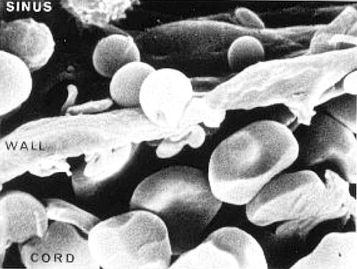 Rat spleen showing a red blood cell leaving the cord and deforming to pass through a slit in the wall of the sinus. Slide provided by Dr Mohandas Narla. Reproduced with permission from: Mohandas Narla. Red cell membrane dynamics and organization. In: UpToDate, Basow, DS (Ed), UpToDate, Waltham, MA 2012. Copyright © 2012 UpToDate, Inc. For more information visit www.uptodate.com.