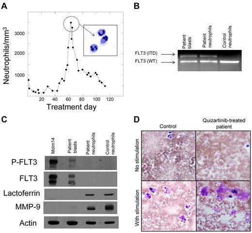 Figure 2. Neutrophils are derived from the leukemic blasts. (A) Graph of peripheral blood absolute neutrophil count from patient 4 during treatment with quizartinib. Neutrophils from day 60 were isolated to > 95% homogeneity as described in “Methods,” which was confirmed by cytospin (inset). (B) Genomic DNA samples isolated from pretreatment blasts, day 60 neutrophils, and neutrophils from a healthy donor were analyzed by PCR for the FLT3/ITD mutation, as described in “Methods.” Shown is an ethidium bromide–stained agarose gel. WT indicates wild-type. (C) Whole-cell lysates were prepared from Molm14 cells, pretreatment blasts from patient 4, day 60 neutrophils from patient 4, and neutrophils from a healthy donor. Lysates were analyzed for total FLT3, phosphorylated FLT3, lactoferrin, and MMP9, as described in “Methods.” (D) NBT reduction assay of peripheral blood collected from a healthy donor (“Control”) compared with a quizartinib-treated patient during the neutrophil surge. Cells “with stimulation” were exposed to bacterial extract to induce respiratory burst activity.
