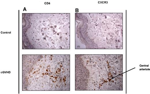 Figure 4. CD4+ and CXCR3+ T cells are elevated in the skin of SCT patients with cGVHD. Shown are the results of immunohistochemical analysis of CD4 and CXCR3 tissue distribution in control healthy skin and in SCT patients with cGVHD. Paraffin-embedded, antigen-retrieved tissue sections were incubated with CD4 (A) and CXCR3 (B) mAbs plus secondary anti–mouse/rabbit HRP. Staining was developed with DAB chromogen and sections counterstained with hematoxylin. Images were taken at room temperature on a Zeiss Axioscop 40 microscope with a Zeiss AxioCam MRc5 camera, magnification 40×/0.65 air. Images were acquired with AxioCam Version 4.4 software, and analyzed using ImageJ Version 1.46 software.