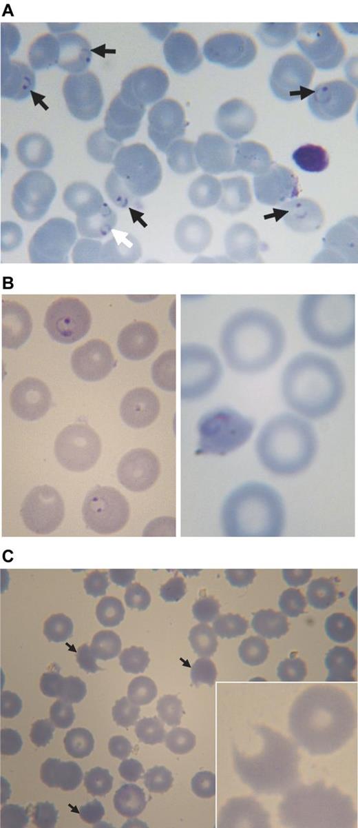 Figure 4. Blood smears from a 3-year-old boy with acute malaria and G6PD deficiency treated with chlorproguanil-dapsone. (A) Pretreatment: black arrows point to erythrocytes parasitized by P falciparum (ring forms), the white arrow points to an erythrocyte containing 2 rings of P falciparum. (B) Approximately 24 hours after starting treatment (day 1): on the left abnormally shaped parasites are seen within spherocytes, on the right a parasite in a severely contracted erythrocyte. (C) On day 3: numerous contracted erythrocytes, spherocytes, and hemighosts (often referred to as “bite cells”; arrows). Inset: another hemighost at a greater magnification; the part of the erythrocyte that appears to be missing is the negative image of a Heinz body.51 Slides were prepared with Giemsa stain and Zeiss immersion oil. An Orthoplan light microscope was used (Leitz). Panel C (except the inset) was taken with an objective Plan-Apochromatic ×63 oil, aperture number 1.4 (Zeiss). The inset to panel C and all other photos were taken with objective ×100 oil, aperture number 1.3 (Leitz). Imaging was with a ProgRes C10plus (Jenoptik-Laser Optik Systeme) with acquisition software ProgRes Capture Basic (Jenoptik) running under Windows XP on a personal computer (assembled).