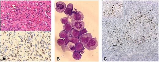 Figure 1. Histologic and immunocytochemical features of posttransplantation HHV8-related neoplastic diseases. (A) Top panel: KS. Hematoxylin and eosin–stained section of a skin lesion characterized by typical “spindle-like” neoplastic cells and surrounding “slit-like” vascular spaces (original magnification ×200). Bottom panel: On contiguous section from the same skin biopsy, LANA-1 immunostaining demonstrated HHV8 latent infection in the neoplastic spindle-like cells, within the KS lesion (original magnification ×200). (B) PEL: cytospin preparation from pleural effusion, showing a massive aggregate of neoplastic lymphoid cells with 2 evident mitotic figures. May-Grünwald-Giemsa stain typically revealed immunoblastic cells with dark basophilic cytoplasm and anaplastic cells with prominent scant light staining basophilic cytoplasm (original magnification ×600). (C) MCD: LANA-1 immunostaining in lymph node biopsy showing typical MCD-associated pattern, with positive plasmablastic B cells surrounding the follicular center (original magnifications ×100 and ×200).