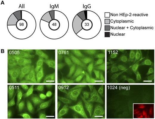 Figure 1. Self-reactivity of recombinant FL Igs. Expressed Igs cloned from FL B cells were tested for self-reactivity by an indirect IFA on HEp-2 cells. (A) Summary of the frequency of self-reactive tumor Igs and the cellular localization of recognized antigens. The number of Igs tested is indicated in the center of the pie chart. (B) Examples of HEp-2 IFA staining patterns. Staining patterns of reactive Igs were confirmed in at least 2 independent experiments. Bars represent 25 μm.