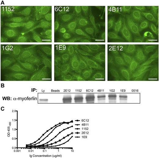 Figure 4. Igs of 1152 tumor subclones retain self-reactivity and antigen binding. (A) HEp-2 IFA staining pattern of tumor subclone Igs (2E12, 6C12, 4B11, 1G2, and 1E9) were obtained through rescue fusion of cells from the tumor biopsy of patient 1152; 1152 corresponds to the recombinant tumor Ig from patient 1152. Bars represent 25 μm. (B) Immunoblot for myoferlin in immunoprecipitations from lysate of 293T cells transfected with recombinant myoferlin-HA construct. Ly indicates lysate; B, lysate IP with protein G beads only; and 0516, an unrelated tumor Ig. (C) Tumor subclone Igs were tested for binding to recombinant myoferlin by ELISA. Recombinant Myoferlin-HA protein was immobilized using anti-HA antibodies on lysate from transfected 293T cells. Data shown are representative of at least 2 independent experiments.