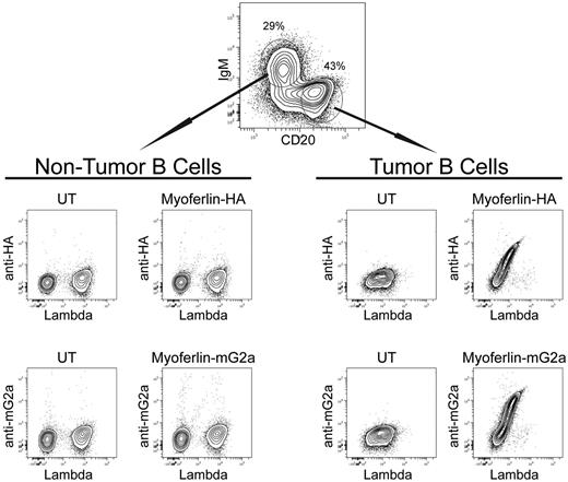 Figure 5. Antigen binding by tumor cells of patient 1152 correlates positively with BCR expression. A single-cell suspension of the tumor biopsy was analyzed by flow cytometry to assess antigen binding by individual cells. Recombinant myoferlin with an HA tag or fused to mouse IgG2a FC was used to stain the cells. Antigen binding was detected with goat anti-HA or goat anti–mouse IgG2a. Lysate from untransfected 293T cells served as a negative control (UT). Cells are gated on CD3−CD20+ B cells; tumor B cells and nontumor B cells were identified with CD20hiIgM− and CD20intIgM+ gates, respectively.