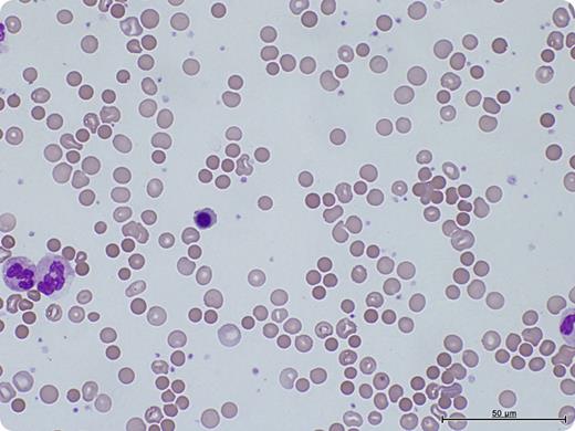 A 64-year-old male underwent a bilateral sequential lung transplant for chronic obstructive pulmonary disease. The donor blood group was O-positive; recipient was A-positive. His hemoglobin fell from 134g/L preoperatively to 93g/L postoperatively and continued to fall to 79g/L 10 days after transplantation. There was no obvious bleeding source. Despite transfusion of 2 units of resuspended red blood cells, there was no improvement. Hemolytic markers were suggestive of hemolysis (raised lactate dehydrogenase, raised bilirubin, and reduced haptoglobin). Blood film showed marked spherocytosis, polychromasia, and nucleated red blood cells (see figure). Direct antiglobulin test was positive, with an elution revealing anti-A1 antibodies. The immune-mediated hemolysis resolved with observation and support with O-positive red blood cells. / Passenger lymphocyte syndrome is an important cause of anemia after solid organ and stem cell transplant occurring 3 to 15 days after transplantation. It is caused by lymphocytes within the donor organ producing antibodies against the recipient's red blood cells. Patients with lung and heart transplants are at high risk for passenger lymphocyte syndrome. It is usually a self-limiting condition, although severe cases have been treated with immunosuppression, plasma exchange, and red cell exchange. Because of the variability in severity and duration, close monitoring until resolution is recommended.