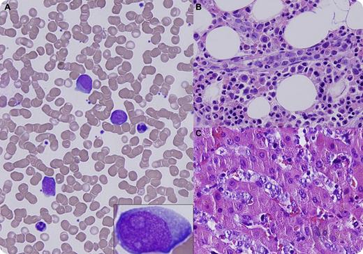 A 59-year-old man presented with acalculous cholecystitis and hepatomegaly. Routine laboratory tests were remarkable for thrombocytopenia (125 × 109/L), alanine aminotransferase 95 U/L, aspartate aminotransferase 760 U/L, alkaline phosphatase 223 U/L, and lactate dehydrogenase 3755 U/L. A peripheral smear showed morphologically normal red blood cells and large atypical lymphoid cells (panel A and inset). Cholecystectomy, liver biopsy, and bone marrow biopsy were performed. Flow cytometry on bone marrow and peripheral blood demonstrated a population of λ-restricted B cells that were positive for CD19, CD20, and CD22, and coexpressed CD5 and CD10. Histologic sections showed large atypical lymphoid cells within small subserosal vessels of the gallbladder, as well as within hepatic (panel C) and bone marrow sinusoids (panel B). Immunohistochemistry showed strong positivity for CD20, PAX-5, CD5, CD10, and Ki-67. Fluorescent in situ hybridization revealed a distal deletion of BCL6 and 3 to 5 copies of BCL2. Cerebrospinal fluid examination was unremarkable. / Intravascular large B-cell lymphoma (IVLBCL) is a rare subtype of extranodal large B-cell lymphoma characterized by intraluminal growth of lymphoma cells within small vessels. Circulating lymphoma cells in the peripheral blood happens occasionally. Once called the oncologist's “great imitator,” IVLBCL can mimic, because of its intrinsically widespread nature, diseases in almost any organ and diagnosis requires high vigilance.