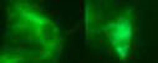 Fig.2:. Distribution of NFKB in cytoplasm or in Nucleus and cytoplasm in cell treated and untreated with Iron Chelator. A: Number of cell having cytoplasmic and ubiquitious NFKB distribution in iron chelator treated cell and DMSO/pPY treated control. . / B: Representative cells having uniform versus cytoplasmic distribution of NF-kB.
