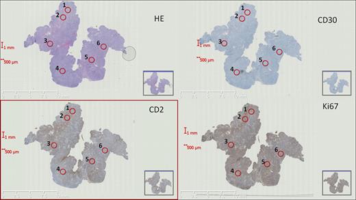 Fig. 1. Digitalized aligned whole sections stained with HE (hematoxylin and eosin), CD30, CD2, and Ki67 (magnification ×0.44). Red rings 1–6 correspond to virtual TMA cores.