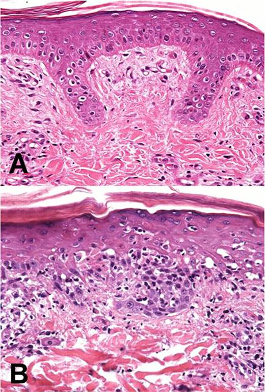 Figure 1:. Comparison of normal porcine skin (A) resembling epidermal and dermal layers of human integument, and (B) recipient skin 34 days post DLI, showing brisk superficial lymphoid infiltrate associated with basal layer epidermal apoptosis.