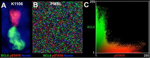 Figure 1. Mutually exclusive distribution of BCL6 and pSTAT6 in PMBL