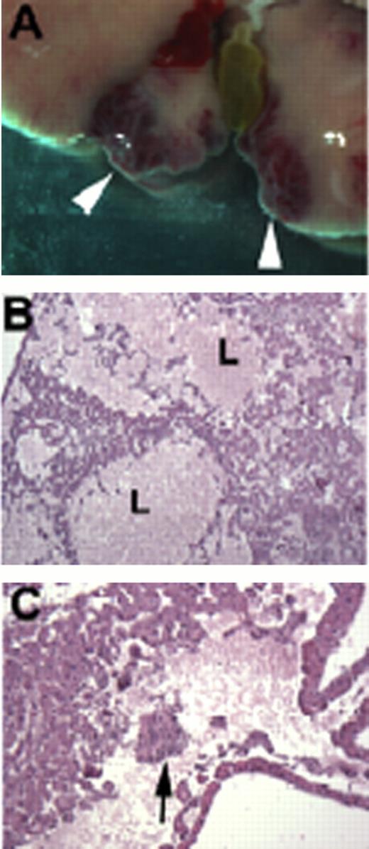 Fig. 1. Liver lesions in HOXB7-Vhl mice. A: Blood filled bulges form close to the gall bladder (arrowheads). B, C: Histology. Note lakunae of blood (L) without endothelial lining (B), and foci of progenitor cells (arrow in C).