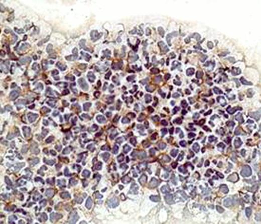 Fig 1. FAK expression in MDS CD34+ cells by immunohistochemistry.