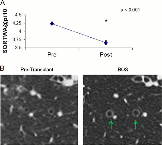 Figure 2. A. Ten BOS patients with Pre BOS diagnosis HRCT scans (on or before transplant) and post diagnosis BOS HRCT scan. * Pre BOS vs. BOS p<0.001 . / B. Representative image of pre-transplant CT scan and post diagnosis BOS CT scan demonstrating airway dilation.