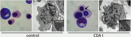 Figure:. Patient iPSC-derived erythroblasts recapitulate CDA I pathology. Light microscopy and transmission electron microscopy (TEM) of normal and CDA I iPSC-derived erythroblasts generated in ∼30 day differentiation cultures. Inserts show higher magnification of the marked areas. CDA I cells exhibit occasional internuclear bridges on light microscopy (third panel). TEM showed abnormal spongy chromatin structure in most CDA I erythroid precursors (fourth panel).