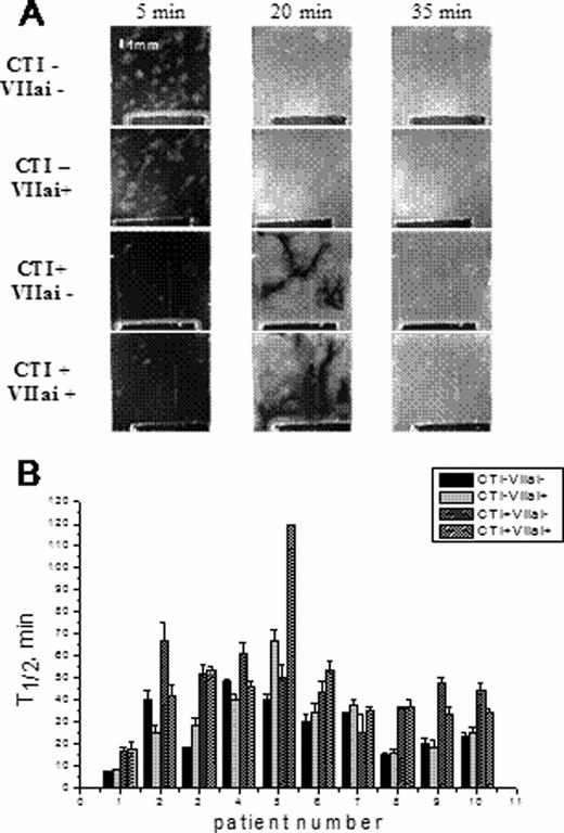 Fig. 1. Contribution of the intrinsic and extrinsic pathways to SC formation. . / (A) Typical clot growth images in plasmas of patients, either untreated, or supplemented with VIIai (50 nM), or with CTI (200 μg/ml), or both. Note formation of numerous fibrin clots independent of the TF-iduced thrombus growth (on the bottom of each image). (B) Spontaneous clotting times for ten different patients as determined in the four experimental designs shown in panel A. In most patients, the role of contact pathway is the predominant one.