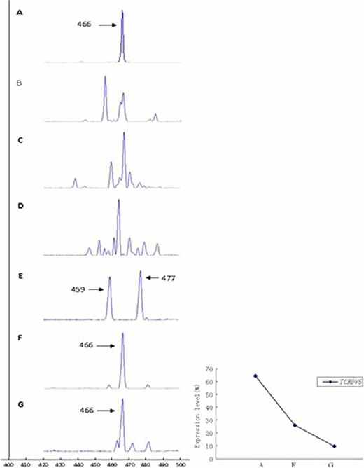 Fig. 1. The clonality and size of V¦Ä5 T cells from a patient with T-ALL at different time points before and after allo-HSCT. A: T-ALL relapse before allo-HSCT. The monoclonal V¦Ä5 product size was 466 bp; B: pre-HSCT; C: 4 weeks post allo-HSCT; D: 8 weeks post allo-HSCT; E: 68 weeks post allo-HSCT. The clonal V¦Ä5 products were 459 and 477 bp. F: 100 weeks post allo-HSCT and disease relapse and G: 108 weeks post allo-HSCT and after one chemotherapy cycle. The same 466 bp monoclonal V¦Ä5 product is observed. The right figure demonstrates the expression level of the monoclonal V¦Ä5 gene at different time points.