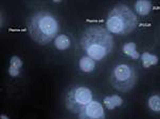 Figure 1. Kappa/lambda positively stained plasma cells showing FGFR3/IGH translocation