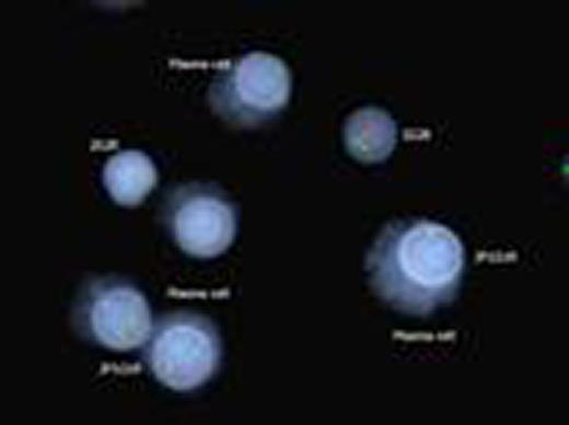 Figure 1. Kappa/lambda positively stained plasma cells showing FGFR3/IGH translocation
