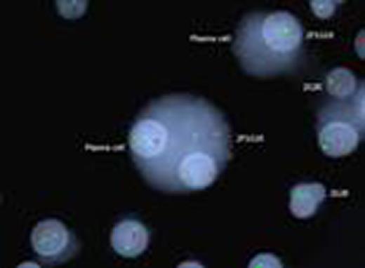 Figure 1. Kappa/lambda positively stained plasma cells showing FGFR3/IGH translocation