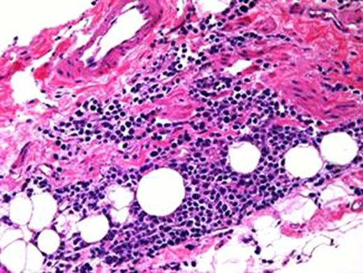 Seroma cavity at x20