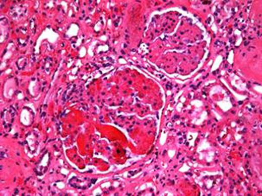 Right kidney TMA at x20