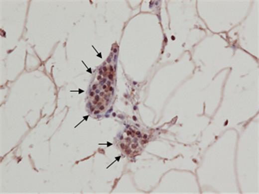 Figure 1. Immunostaining of transbronchial lung biopsy tissue for anti-LR11 antibody, showing LR11-positive lymphoma cells (arrow) increasing in lumina of small vessels.