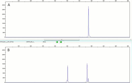 Figure 1. Assay Results for NOTCH1 PEST Domain Mutations . / A – Wild Type NOTCH1 revealed by the presence of a single 391 bp peak. . / B – Presence of heterozygous c. 7544_7545delCT mutation evidenced by the presence of a 356 bp peak, corresponding to the allele specific pcr peak; and a double peak at 391 bp and 389 bp positions, corresponding to the wild type product (391 bp) and to the mutated product (389 bp) detected with the wild type primers.