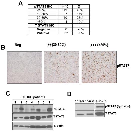 Figure 1. Detection of pSTAT3/STAT3 expression on untreated DLBCL tumors. (A) By immunohistochemistry (IHC). (B) Representative pSTAT3 staining in paraffin-embedded tissues from DLBCL tumors (original magnification ×400). (C-D) Western blotting was performed to assess pSTAT3 and tSTAT3 expression in DLBCL patients (n = 7; C); CD19+ normal B cells (n = 2); and DHL2 (DLBCL cell line; D).