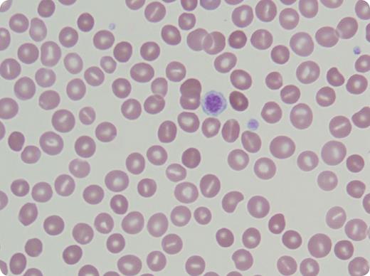 A 47-year-old white male was referred for chronic thrombocytopenia of 80-90 × 109/L and splenomegaly since 1997. He had been treated unsuccessfully, and mistakenly, for immune thrombocytopenia (steroids, rituximab, romiplostim, and anti-D that produced severe hemolysis requiring hospitalization). Previous bone marrow biopsies were nondiagnostic and an earlier liver biopsy showed steatosis. A cholecystectomy had been performed for gallstones. Family history was negative. In addition to mild splenomegaly, he presented with xanthomas. Labs showed hemoglobin 12.3 g/dL, haptoglobin 2 mg/dL, indirect bilirubin 2.4 mg/dL, and an elevated absolute reticulocyte count 240 mil/L. Direct antiglobulin test and flow cytometry for paroxysmal nocturnal hemoglobinuria were negative. Osmotic fragility was increased. Peripheral smear revealed stomatocytes and macrothrombocytes (see figure) consistent with hereditary sitosterolemia. The patient's sitosterol level was 166.0 mg/L (0-5) and campesterol 84.9 mg/L (0-7). / Sitosterolemia is a rare autosomal recessive disorder involving the ATP-Binding Cassette G (ABCG) proteins ABCG5 and ABCG8 that help prevent sterol absorption and promote excretion of plant sterols. Absent their function, plant sterols accumulate in the blood and onto the red cell membrane inner layer, resulting in stomatocytes. The mechanism of macrothrombocytes is not understood, but the total platelet mass is usually normal. These proteins are not expressed on red blood cells or platelets. The morphologic defects are acquired. Examination of the peripheral smear led to diagnosis of sitosterolemia, the syndrome of stomatocytes, hemolytic anemia, thrombocytopenia, and macrothrombocytes.