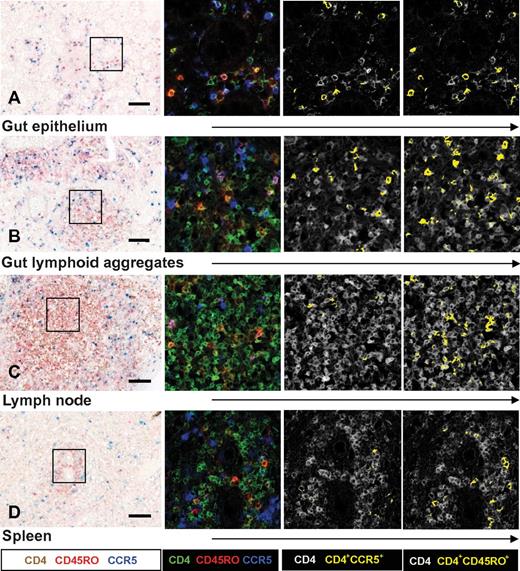 Figure 1. Expression of CD4, CCR5, and CD45RO cells in neonatal tissue determined by triple immunohistochemical staining for CD4, CCR5, and CD45RO visualized with spectral imaging and at higher magnification. The first column shows immunohistochemistry light microscopy. The following columns show the same cubes analyzed with Nuance software for spectral imaging. These analyses indicated more CD4+CCR5+ and CD4+CD45RO+ T cells (yellow) in the gut epithelium (A) and gut lymphoid aggregates (B) of newborn infants than in lymph nodes (C) or spleen (D). Scale bar indicates 0.1 mm. Data are representative of patients 1-10 included in our study.