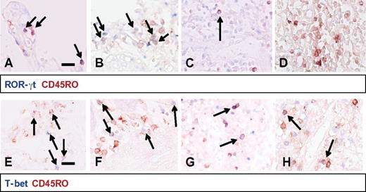 Figure 3. Th cell subsets in neonatal tissues. In the top panels (A-D), RORγt+ (blue) and CD45RO+ (red) double-positive cells were detected in large numbers in the gut epithelium (A) and gut lymphoid aggregates (B). RORγt+CD45RO+ cells were virtually absent in lymph nodes (C) and undetectable in the spleen (D). In gut epithelium (E), T-bet+CD45RO+ cells made up approximately 35% of the CD45RO+ cells and these cells were also present to a lesser extent in the gut lymphoid aggregates (F) and nearly absent in the lymph nodes (G). In the spleen (H), T-bet+CD45RO+ cells represented the largest CD45RO+ T-cell subset. These panels are representative of patients 1-10 included in our study. Scale bar indicates 0.1 mm.