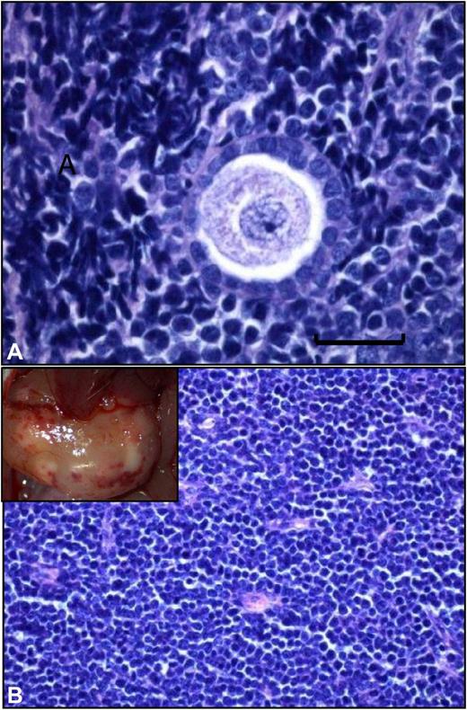 Grafted frozen-thawed ovarian tissue from a leukemia patient. (A) Histologic analysis of a frozen-thawed ovarian fragment from a leukemia patient recovered from a mouse after 6 months' xenografting. Normal ovarian stroma is no longer present, and a human follicle encircled by a large number of proliferating malignant lymphocytes can be seen (scale bar = 20 μm). (B) Large, white, burgeoning mass that corresponded to massive peritoneal invasion by leukemic cells.