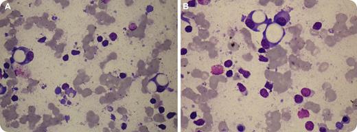 A 70-year-old woman presented with a 4-month history of severe back pain, generalized weakness, and 12-kg weight loss. A spine MRI revealed multiple lytic lesions and collapses of T5 and T7. She had mid-thoracic tenderness and hepatosplenomegaly, but no lymphadenopathy. Hemoglobin was 10.2 g/dL, leukocytes 50.3 × 109/L (88% lymphocytes), and platelets 130 × 109/L. Peripheral smear showed many smudge-cells with an immunophenotype consistent with chronic lymphocytic leukemia (CLL). Serum protein electrophoresis was unremarkable. A bone marrow examination showed marked infiltration with lymphocytes, and increased numbers of plasma cells (18%). Many plasma cells contained 1 to 3 large, clear, PAS-negative cytoplasmic vacuoles (see figure panels). These clinical and morphologic findings raised the suspicion of μ-heavy-chain disease (μ-HCD). Serum immunofixation revealed an M-band typed as IgM without corresponding light chain, thus confirming the diagnosis. A 24-hour urine collection contained 2.84 g of protein consisting of free κ-light chains. The patient received chemotherapy and local radiotherapy with substantial improvement. / μ-HCD is a rare B-cell neoplasm resembling CLL, but differing clinically by lytic bone lesions, hepatosplenomegaly, and the absence of lymphadenopathy. This heavy-chain disorder is characterized by synthesis of monoclonal μ-chain fragments lacking VH region and in part CH1, with an inability to bind light-chain. Associated light-chain proteinuria and skeletal involvement may occur. The absence of M-component on routine electrophoresis may preclude recognition of the disorder. The morphologic clues in this case were the plasma cells with striking vacuoles.