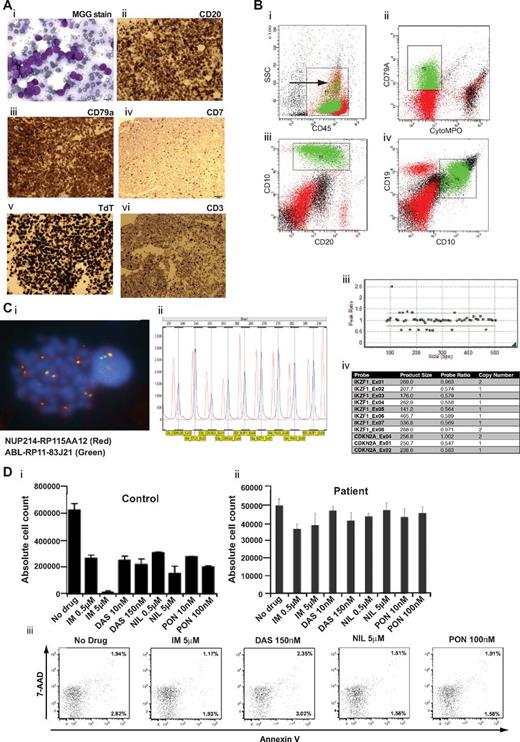 Figure 1. Characterization of episomal NUP214-ABL1 B-ALL and in vitro sensitivity of patient blasts to TKI. (Ai) May-Grunwald-Giemsa stain of blasts from a trephine roll. (ii-vi) Immunocytochemical stains of trephine sections stained with antibodies indicated above each panel. (Bi-v) Flow cytometric analysis of marrow blasts. (i) Cell populations in the blast cell gate (CD45+ and of the indicated side scatter (SSC) were studied further in subsequent panels. (ii-iv) Expression of the indicated cell surface and cytoplasmic (cyto) antigens was studied on blast cell populations. (Ci) FISH analysis of a blast cell with probes specific for ABL1 (green) and NUP214 (red). Two green and red signals indicate normal chromosomal ABL1 and NUP214. Yellow signals indicate location of fusion gene. (ii-iv) MPLA analysis shows deletion of IKZF1 exons 2-7 and CDKN2A exons 1-2. (D) Absolute cell counts of viable control BV173 (i) and patient primary blasts (ii) after 72 hours in culture with either no drug or the indicated concentration of imatinib (IM), dasatinib (DAS), nilotinib (NIL), or ponatanib (PON). (iii) FACS plots of aliquots of patient's cells after 72 hours of culture showing annexin V and 7-amino-actinomycin D (7-AAD) expression.