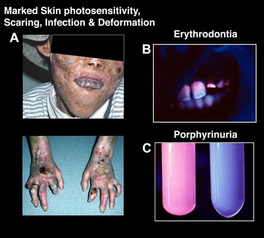 Figure 3. Congenital erythropoietic porphyria. (A) A severely affected CEP patient who has had multiple sun-induced skin lesions. The cutaneous bullae and vesicles burst and became secondarily infected, leading to bone involvement and resultant loss of facial features and digits. (B) Note his brownish discolored teeth, which fluoresce (erythrodontia) when exposed to ultraviolet light. The erythrodontia is the result of the accumulation of uroporphyrin I and coproporphyrin I in his teeth. (C) Urine from a CEP patient that fluoresces red under ultraviolet light (left) and from a healthy person (right).