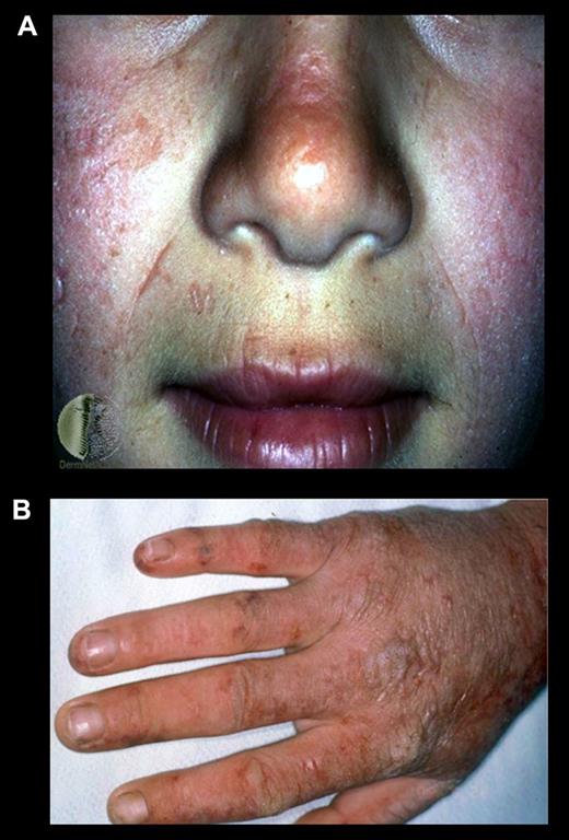 Figure 4. Erythropoietic protoporphyria. (A) An EPP patient after sun exposure. Note the reddish and swollen appearance of her face and (B) scarring and thickening of the skin on the dorsum of her hand because of multiple sun/light exposures.
