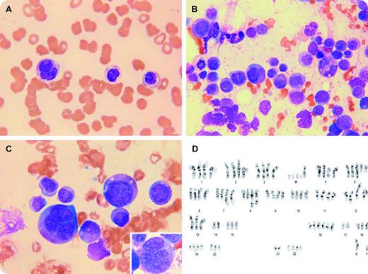 A 74-year-old man with colorectal carcinoma treated with surgery and adjuvant chemotherapy with oxaliplatin and fluorouracil 6 years previously was admitted with fever and suspicion of sepsis. Laboratory tests showed hemoglobin 137 g/L, mean corpuscular volume 94.7 fL, platelets 177 × 109/L, leukocytes 2.0 × 109/L, and neutrophils 0.8 × 109/L. Within 4 days his condition deteriorated rapidly with progressive pancytopenia and severe neutropenia. A peripheral blood smear showed hyposegmented neutrophils (pseudo–Peger-Huët cells) and abnormal granulation (see figure panel A). A bone marrow aspirate revealed markedly dysplastic changes predominantly affecting granulocytic precursors with multinucleated forms and dysplastic granulation (panel B, panel C inset). Cytogenetic analysis showed a complex karyotype with multiple numeric and structural anomalies (panel D; G-banded karyogram of 1 metaphase cell of the bone marrow showing hypotetraploidy with 88 chromosomes and multiple anomalies including several derivative and dicentric chromosomes, duplications, robertsonian translocations, and 5 markers). The patient's condition did not improve and he died 19 days after admission. / Infection with pancytopenia is a common problem. When it occurs in patients with previously diagnosed malignancy, metastatic disease and delayed drug effects are a consideration. In this case, the peripheral smear and marrow revealed myelodysplasia, presumably drug-related.