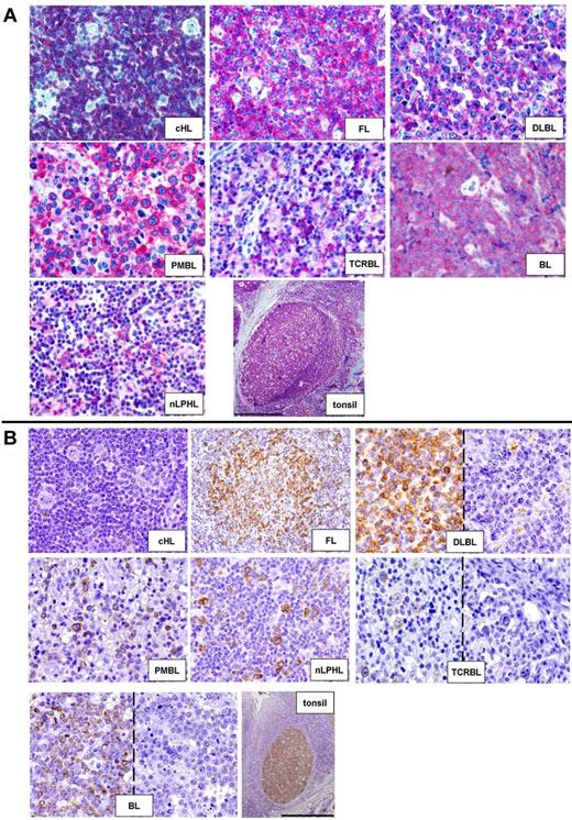 Figure 5. Validation at the protein level of the gene expression data through immunohistochemistry. (A) HRS cells of cHL lack expression of INPP5D/SHIP-1 as opposed to neoplastic cells of the other lymphomas (40× objective) and to non-neoplastic tonsilar follicular B cells (4× objective). Bar represents 500 μm. (B) The BIK protein is absent in HRS cells of cHL, while being mostly expressed by the neoplastic cells of the other lymphomas (for DLBCL, TCRBL, and BL also examples of negative cases are shown; 40× objective). In reactive tonsils, BIK is strongly and selectively expressed by GC B cells (4× objective). Bar represents 500 μm.