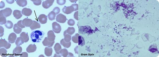 A previously fit 63-year-old woman presented drowsy, breathless, and hypotensive. Observations revealed a fever (38.6°C), hypoglycemia (2.2 mmol/L), hypotension (84/55 mmHg), and atrial fibrillation (140 bpm). Arterial blood gas demonstrated a metabolic acidosis (pH 7.19, lactate 11.4) with significant hypoxia. Laboratory investigations showed hemoglobin 144 g/L, white cell count 2.3 × 109/L, neutrophil count 1.9 × 109/L, and platelet count 9 × 109/L. The activated partial thromboplastin time and prothrombin time were prolonged, along with a depressed fibrinogen level, in keeping with disseminated intravascular coagulation. Wright-stained peripheral blood smear showed highly vacuolated neutrophils; there were a large number of both intra- and extra-cellular Gram-positive diplococci (see arrow in left panel of figure) in keeping with overwhelming sepsis. Gram stain of the peripheral blood smear affirmed the bacteremia. Later, blood culture revealed a fully sensitive Streptococcus pneumoniae, with earliest growth detected at 4 hours' incubation. Despite prompt treatment with intravenous fluids, antibiotics, and blood products, the patient continued in septic shock and died 5 hours after presentation due to cardiac arrest. / Identifying bacteria on a blood smear is a rare finding. When present, it can lead to a diagnosis before any blood cultures become positive. This can be of great value in guiding immediate management in the acute setting.